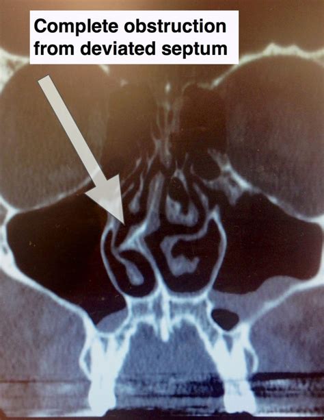 deviated septum - Charleston Facial Plastic Surgery