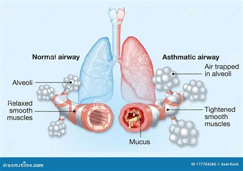 Asthma Normal And Asthmatic Airways Medically Illustration Stock