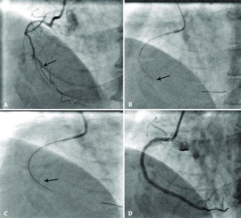 Application Of Orbital Atherectomy In Calcified Lesion A Coronary