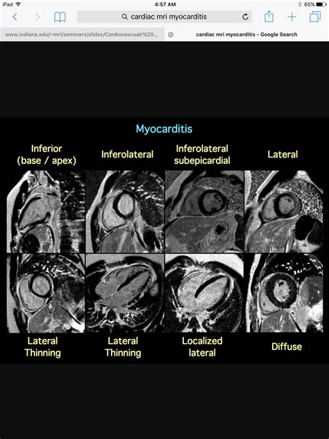 Myocarditis Mri Diagnostic Performance Of Cardiovascular Magnetic