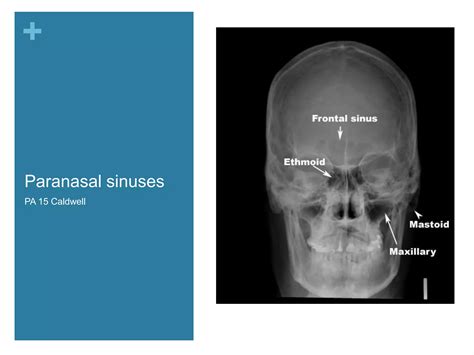 Nasal Cavity And Paranasal Sinuses Radiologic Anatomy Ppt Free Download