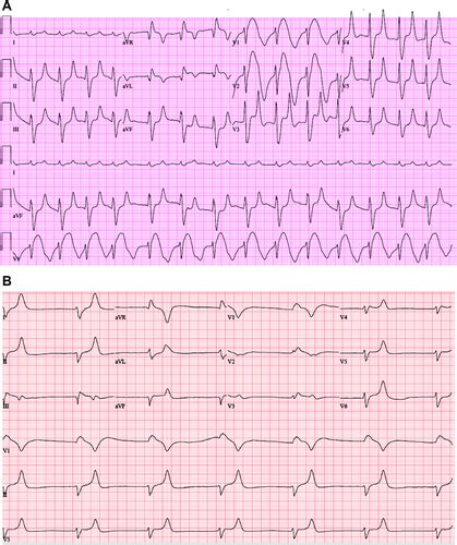 Cardiac Tamponade Ecg