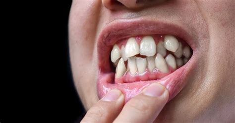 What Is Crowded Teeth Symptoms Causes And Treatment I3D Liner Blog