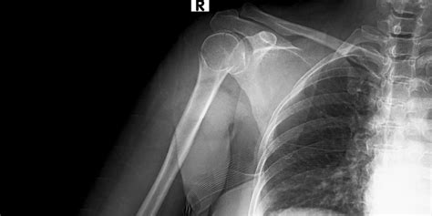 Kość ramienna budowa i funkcje Objawy złamania kości ramieniowej