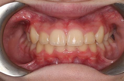 Patient Stories Success Stories Total Orthodontics