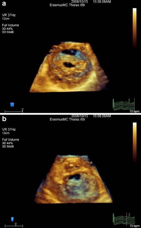 An Example Of Rheumatic Mitral Valve Stenosis As Seen From Left Atrial