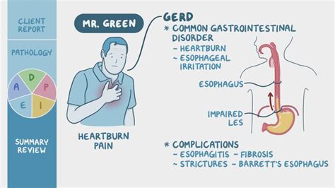 Nursing Considerations For Barretts Esophagus Ask The Nurse Expert