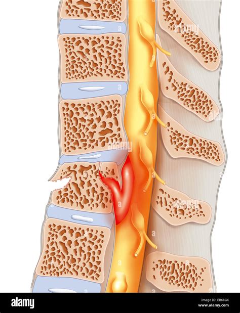 La Lesi N De La M Dula Espinal Fotograf A De Stock Alamy