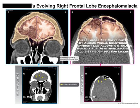 Amicus Illustration Of Amicus Injury Evolving Right Frontal Lobe Encephalomalacia Right Frontal