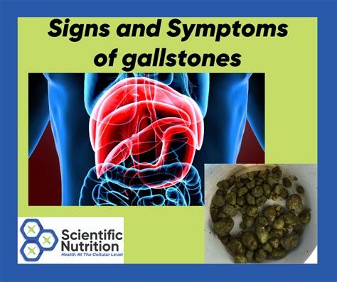 What Gallstones Do To Your Health Symptoms And Warning Signs