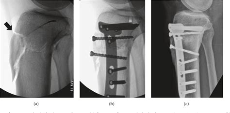 Pdf Open Wedge High Tibial Osteotomy With Distal Tubercle Osteotomy