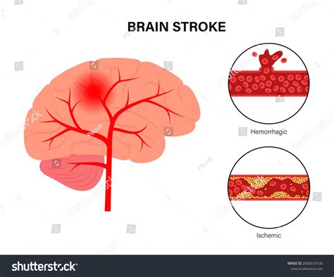 Brain Stroke Hemorrhagic Ischemic Problem Arteriosclerosis Stock Vector