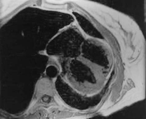 Axial T1 Weighted Spin Echo Image Demonstrates Marked Displacement Of