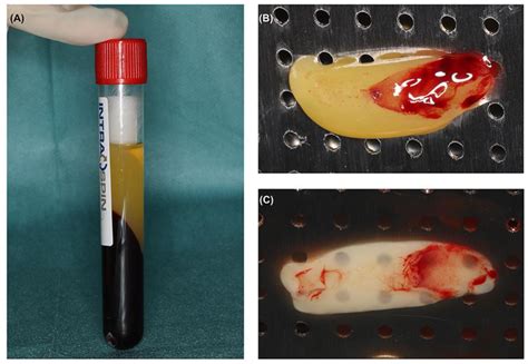 Fibrin Clot In Serum Sample