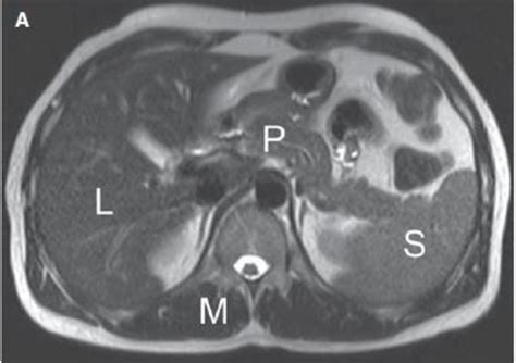 On T2 Weighted Single Shot Fse Tse Images The Normal Liver L Is