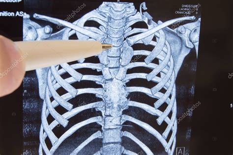 Thoracic spine MRI or CT X-ray image. The doctor points to the thoracic spine X-ray image of the ...