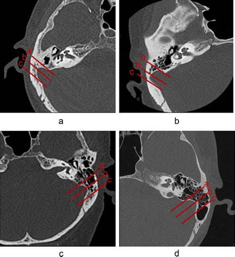 Classification Of The Mastoid Air Cells Macs ‘a Is The Straight