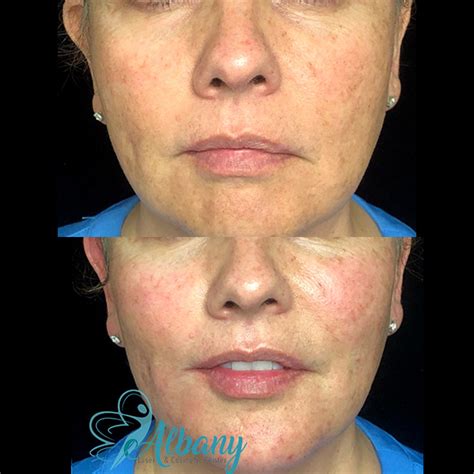 Bellafill Injections Case No 1327 Albany Cosmetic And Laser Centre In