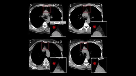 Immune System Aging Detectable Via Ct Scan