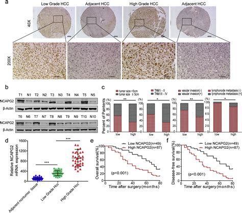 Ncapg2 Overexpression Promotes Hepatocellular Carcinoma Proliferation