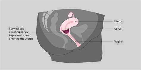 Cervical Cap Insertion