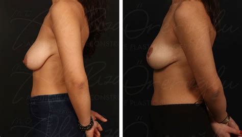 Breast Lift Procedure Providers Photos Cost Belorens