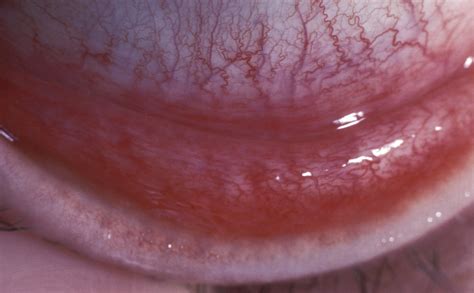 Viral Conjunctivitis Tarsal Conjunctival Follicles That Ar Flickr