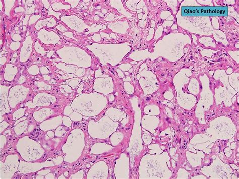 Qiaos Pathology Uterine Adenomatoid Tumor Microscopic Ph… Flickr