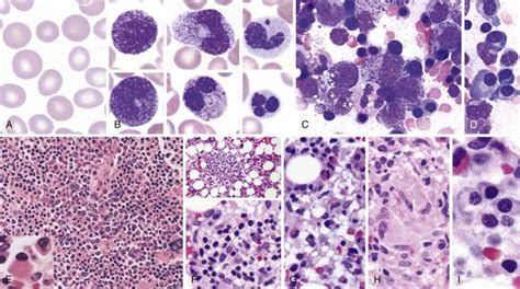 Hematologic Manifestations Of HIV AIDS Clinical Gate