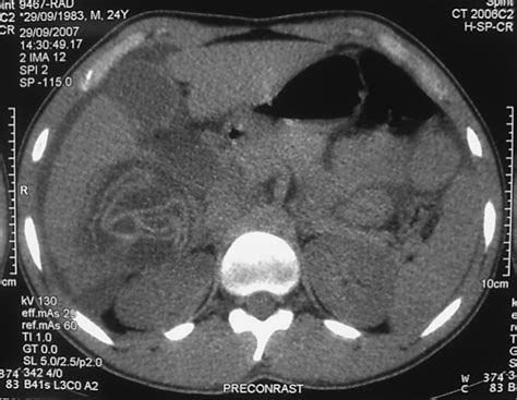 Ct Of Perforated Hepatic Hydatid Cyst Into Peritoneum Download Scientific Diagram