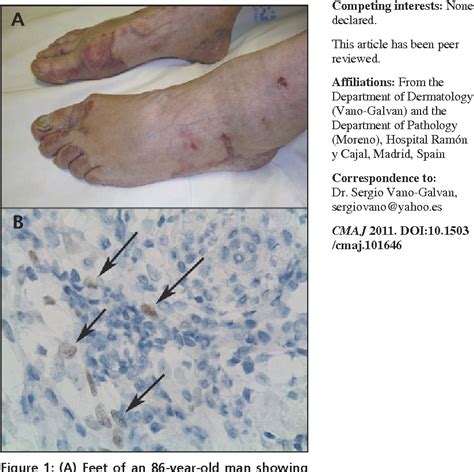 Figure 1 From Classic Kaposi Sarcoma Semantic Scholar