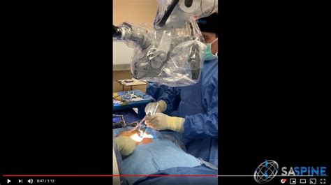 Watch Minimially Invasive Microdiscectomy