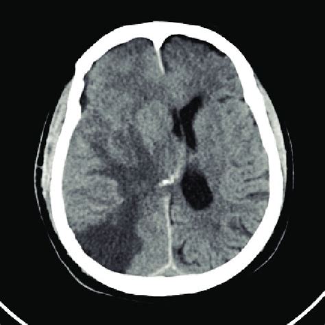 NCCT head shows a large right MCA territory infarct With significant... | Download Scientific ...