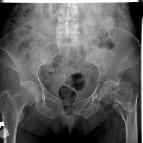 Figure Pelvic Radiograph Left Hip Fracture Contributed By Scott