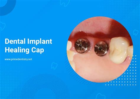 What Is A Dental Implant Healing Cap Prime Dentistry