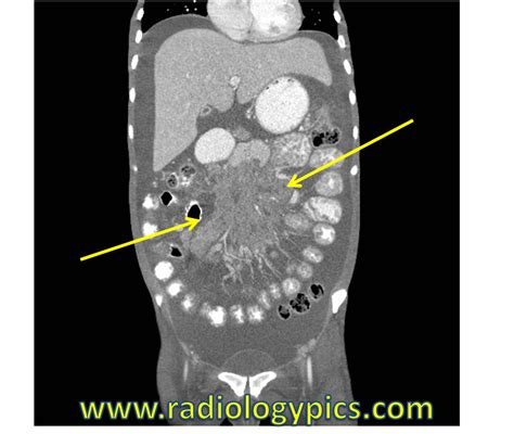 Solution To Unknown Case 21 Mesenteric Lymphadenopathy Differential Diagnosis Radiologypics