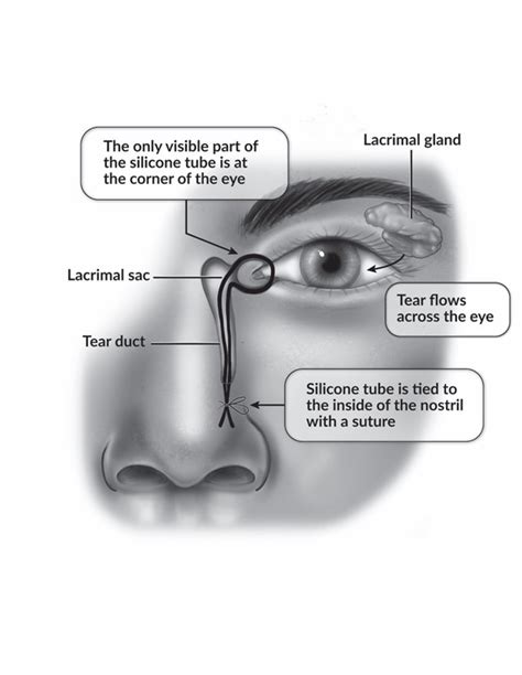 Blocked Tear Duct And Silicone Intubation Treatments Patients And Families Uw Health