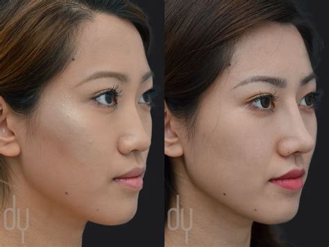 Korean Rhinoplasty Before And After