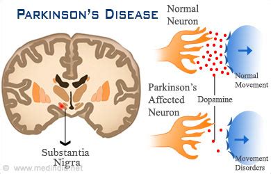 Parkinson S Disease Legacy Spine Neurological Specialists