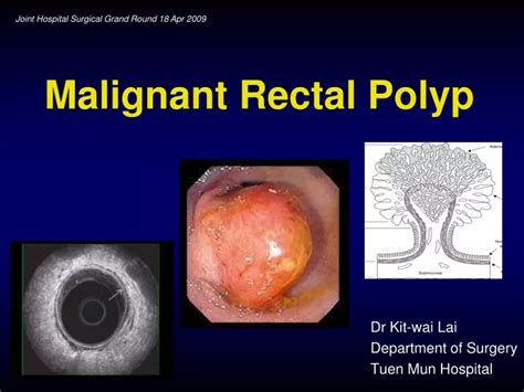 Ppt Malignant Rectal Polyp Powerpoint Presentation Id 432580