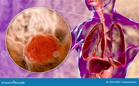 Esophagus Cancer