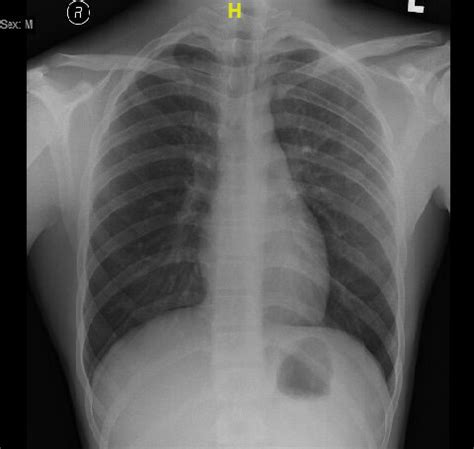 Posterior Anterior Erect Chest X Ray Taken After Days Of Admission