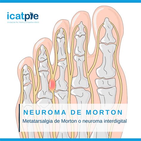 Neuroma De Morton S Ntomas Causas Y Tratamiento Icatpie