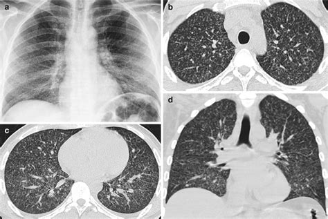 Parenchymal Lung Disease Radiology Key