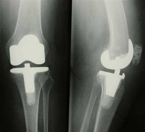 Arthroplastie par prothèse de genou Docteur Stéphane DIDELOT