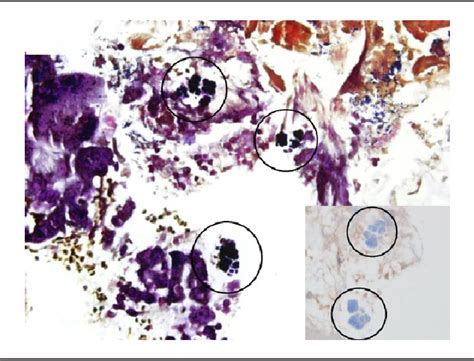 A Rare Case Of Sarcina Ventriculi Of The Stomach In An Asymptomatic