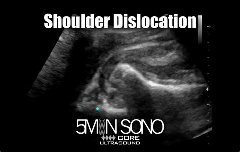 Shoulder Dislocation – Core Ultrasound