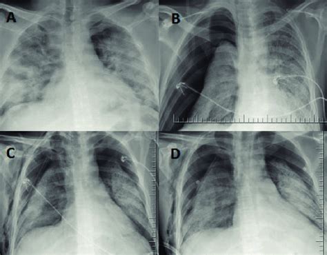 Posterior Anterior Chest X Ray A Widespread Consolidated Areas In