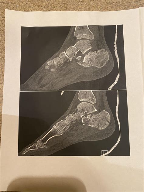 Before and after heel surgery. Fell just over 35 ft. landing on my feet