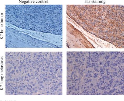 Figure From Fas Negative Osteosarcoma Tumor Cells Are Selected During